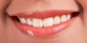 Getting Your Teeth Cleaned Every 6 Months, Teeth Cleaning Importance - Coquitlam Dentist