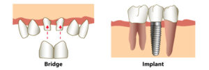 Bridges versus implants in Coquitlam